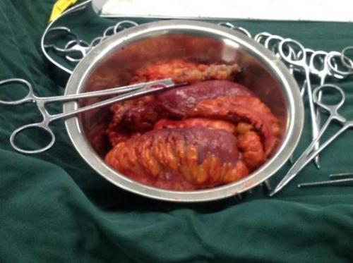 切除息肉可以吃蜜瓜,蜜瓜助力康复之旅